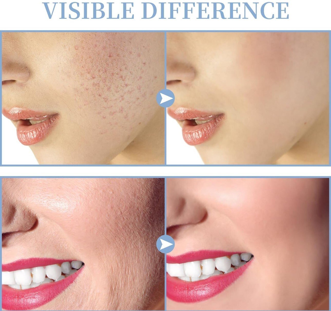 Appareil à haute fréquence|Machine faciale|Stimulation des racines|Santé|TUMAKOU - Image 4